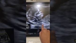 Level 1 scan or NT/ Nb scan