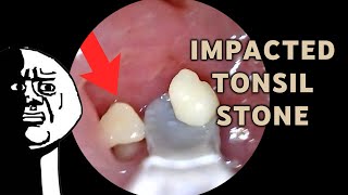 Impacted Tonsil Stone Removal | AIM 21