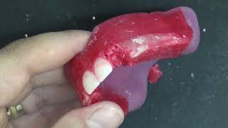 Maxillary Anterior Teeth Setting