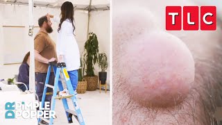 Dr. Lee Needs A Ladder To Check This Patient's Bumps! | Dr. Pimple Popper | TLC