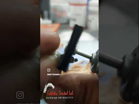 Precision Attachment case #kalaburgi #dentallab #indiandentist #dentistry #rhein83#dentallab#dentist