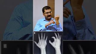 Boxer's Fractures Dr. Soundar