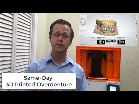 Same-Day 3D Printed LOCATOR Overdenture!!