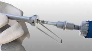 Dual Trak Lateral Entry Technique