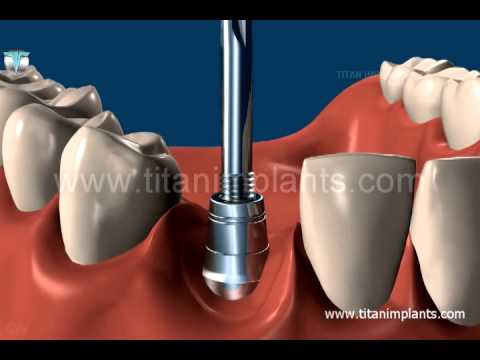 Titan Implants' Implant Locator Pin