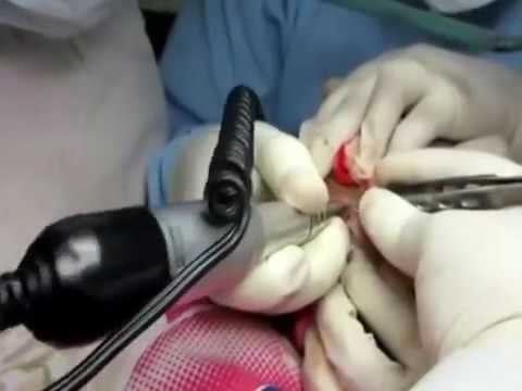 JETSPEED HAIR TRANSPLANT FUE HAIR TRANSPLANT CENTER,INDIA
