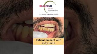 Dirty Teeth Smile Makeover: Teeth cleaning: Dr. Srishti Bhatia #teeth #smile