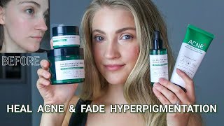 I Tested The SOME BY MI AHA-BHA-PHA 30 Days Miracle Acne Products For 1 Month | Review + Results