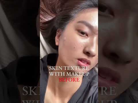 Can you see a difference in my skin?! #acne #shorts #facial