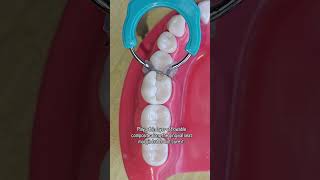 best margimal adaptation in class II composite Restoration| snow plow technique #shorts #dentistry