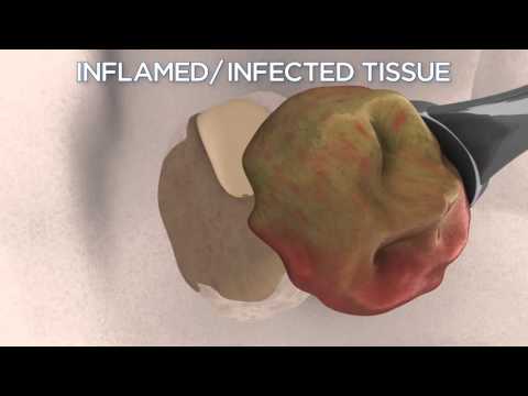 Guide to Endodontic (Root Canal) Surgery (American Association of Endodontists)