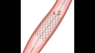 Percutaneous Coronary Intervention (PCI)