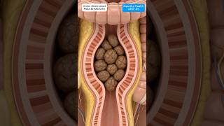 Colon Cross-Section Showing Obstructed Mass Breaking Apart Under Pressure #guthealth#shorts #youtube