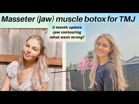 Botox for TMJ - botox injections at 25, does botox hurt, before and after jaw contouring