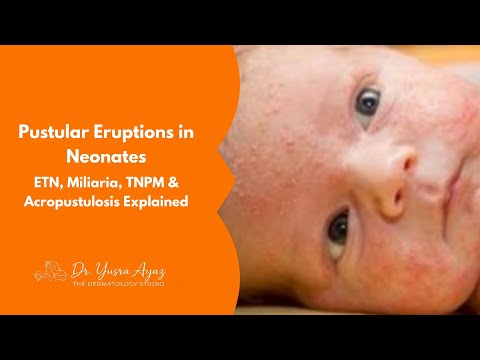 Lecture 2: Pustular Eruptions in Neonates: ETN, Miliaria, TNPM & Acropustulosis Explained