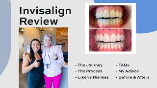 Invisalign Review: I'M DONE + FAQ's, before/after photos, my advice, worth it? | Krengel Dental
