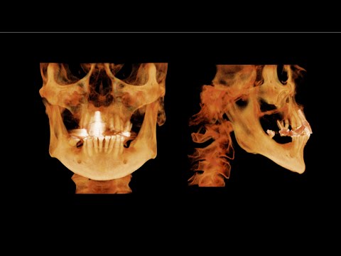 Facially Driven Digital Treatment Planning of the Terminal Dentition