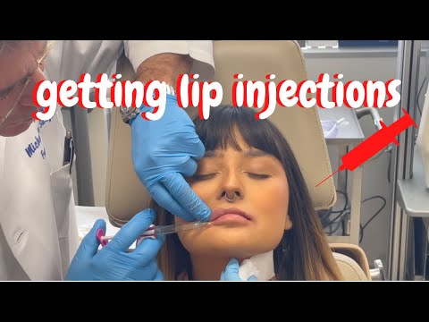 I got my lips injected with | Juvéderm | lip filler