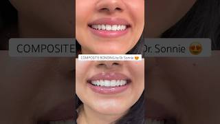 Beautiful composite bonded veneers, complete without the use of drilling or injections. 😍