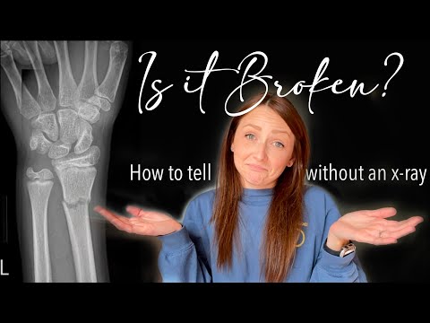Is it Broken? How to tell WITHOUT an X-ray!