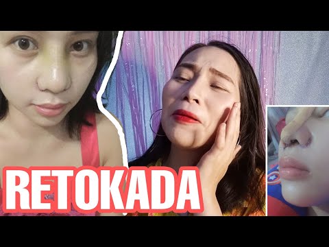 MY NOSE JOB ( RHINOPLASTY ) SURGERY STORY | Retoke Story! How much? Rhinoplasty Philippines
