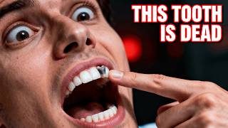 Dead Tooth Symptoms – Discolored, Painful, Silent? (Root Canal?)