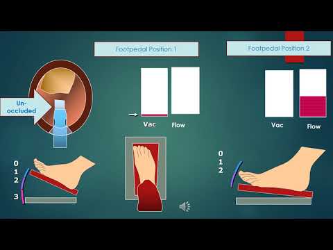 Basics of Phaco -  Part I (for Part II https://www.youtube.com/watch?v=UY6ZdPKPaJ4)  quickguide.org