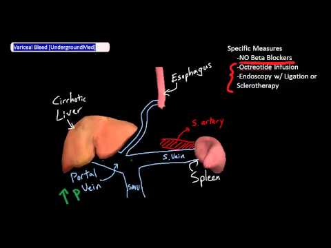 Variceal Bleed Management [UndergroundMed]