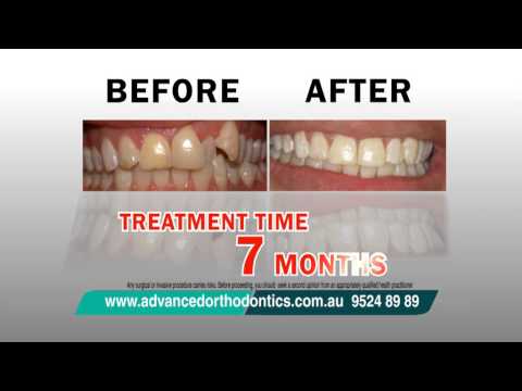 Magic Braces - TV Commerical