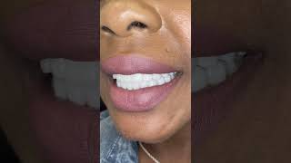 Getting an affordable smile in Miami