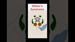 Weber Syndrome: Midbrain Stroke Explained in 60 Seconds! #anatomyshorts #anatomy