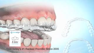 Orthodontist Mesa FAQ Are Invisalign Invisible Braces