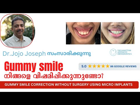 Gummy smile  നിങ്ങളെ വിഷമിപ്പിക്കുന്നുണ്ടോ ? ഇതൊന്നു കണ്ടുനോക്കൂ