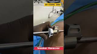 Da Vinci Robotic Surgery Camera Insertion Technique