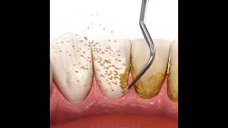 Scaling teeth using Ultrasonic Scaler