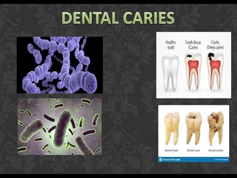 Dental caries (Part 1)
