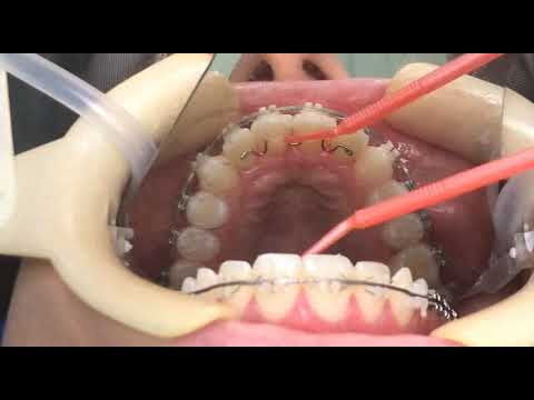 Upper orthodontic hygienic retainer