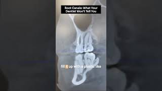 Root Canals: What your dentist won't tell you #shorts