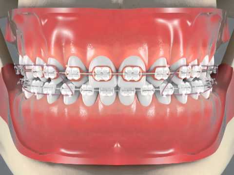 Missing Laterals Incisors Closing Spaces with Drill Center