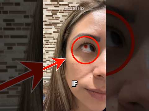 If you look in the mirror and see red patches in your eyes, there's no need to worry