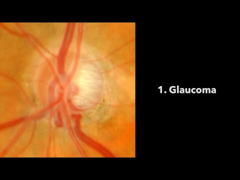 Glaucoma