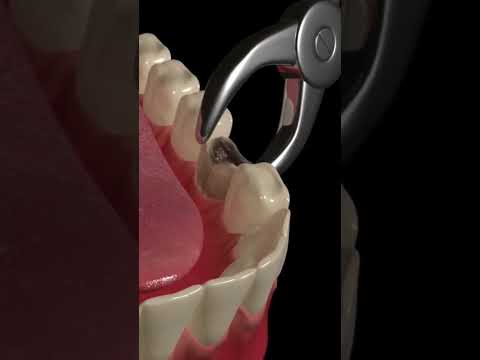 Animated Dental Extraction Procedure