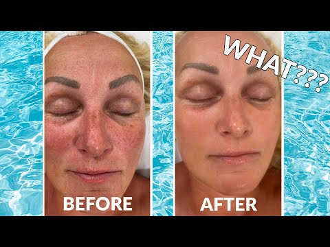 Look 10 Years Younger from this Skin Care Treatment! #skincare