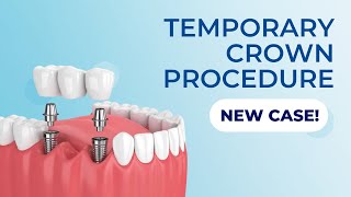 Temporary crown procedure. Benefits of the screw-retained restoration. A temporary restoration.