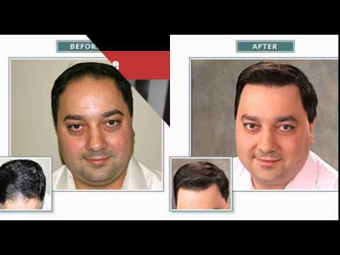 Hair Loss Treatment In India