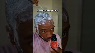 MY SEBORRHEIC DERMATITIS TREATMENT ROUTINE👌🏾‼️pt.2