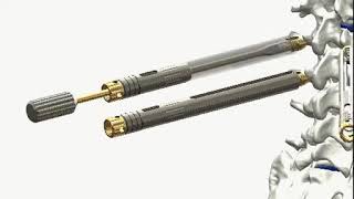 HumanTech Percutaneous Cement Augmentation