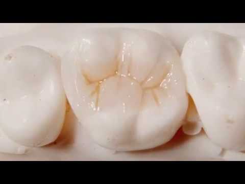 Upper First Molar Composite buildup (step by step)