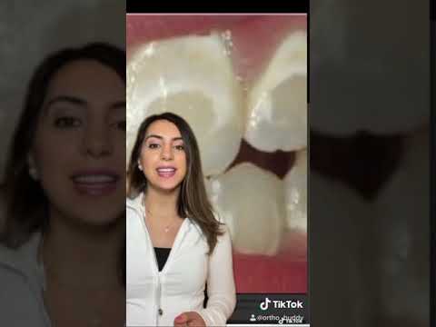 Avoid white spots while wearing #braces! #shorts