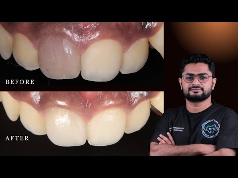 പല്ലുകളുടെ മഞ്ഞ നിറം എങ്ങനെ മാറ്റാം|Amazing teeth whitening| Malayalam|Intra Coronal Bleaching
